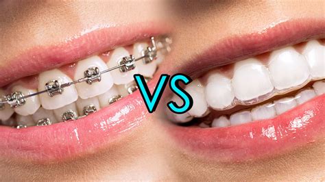 invisible braces vs traditional